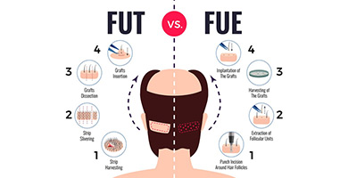 is fut or fue hair transplant